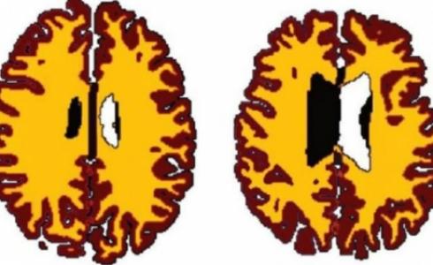تقل المادة البيضاء مع تقدم السن