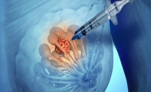 تقنية جديدة لعلاج سرطان الثدي في أسبوع.. تعرف عليها