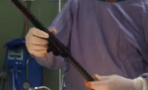 إخراج "سيخ" حديد من ظهر مسن