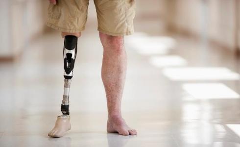 حملة لتركيب اطراف صناعية في لبنان