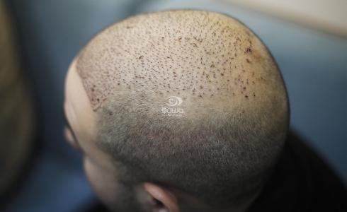 زراعة الشعر في غزة