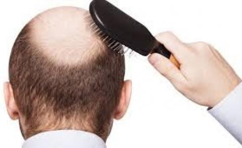 تساقط الشعر -توضيحية-