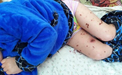 طاقم العناية بمستشفى الدرة ينقذ حياة طفلة تحت الخطر الشديد بسبب فشل في جميع أعضاء الجسم