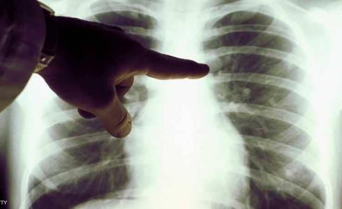 أطعمة مسببة لسرطان الرئة.. احذرها!