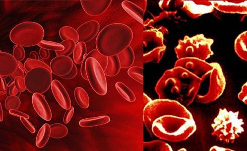  الثلاسيميا