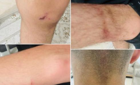 رضوض تظهر على جسد الفتى القاصر مجدي عرار 