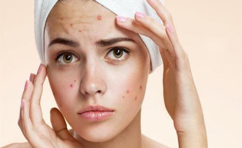 علاج حب الشباب