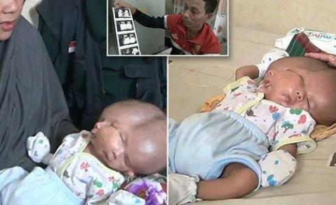 في حادثة نادرة، ولد طفل ذو وجهين، ودماغين في رأس واحد في إندونيسيا.