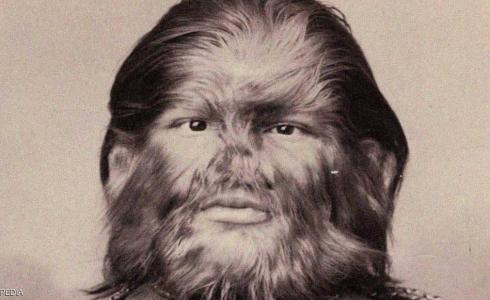 الطفل المستذئب في الهند