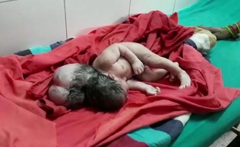 امرأة تنجب طفلتها بثلاثة رؤوس في الهند