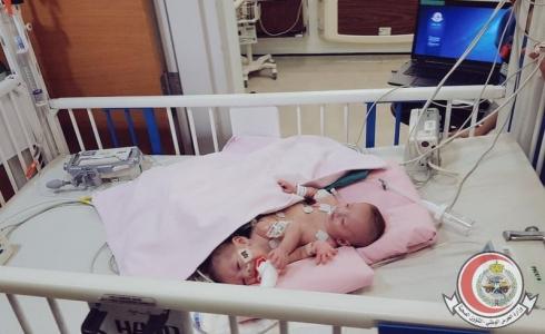 انتهاء مرحلة "التخدير والقسطرة" من فصل توأم سيامي فلسطيني بالسعودية