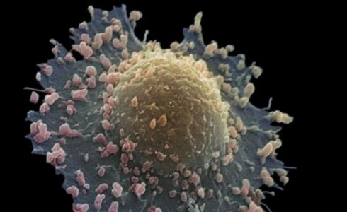 تتجول الخلايا السرطانية التي تصيب الرئتين في الجسم بعد انهيار سطحها الخارجي