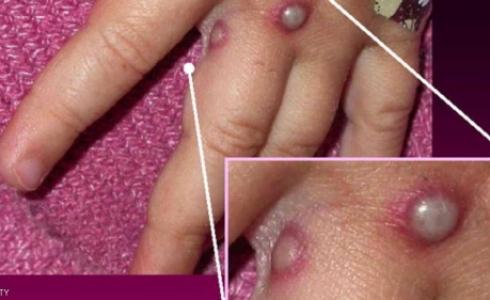 فيروس قاتل يهدد العالم