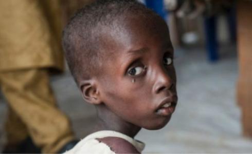طفل بولاية بورنو يعاني من سوء التغذية