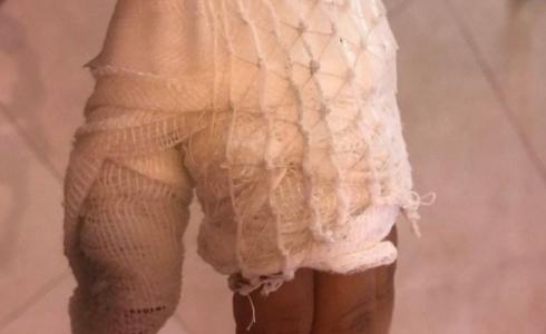 إصابة طفل في أم الفحم بسبب المفرقعات