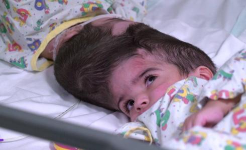 التوأم الملتصق