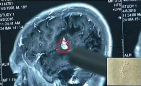 دودة حية تسكن رأسه منذ 17 عاماً 
