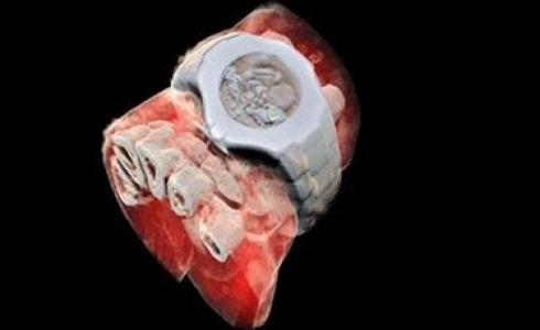 أخذ أول صورة ملونة بالأشعة السينية