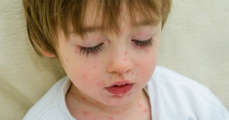 أمراض الجلدية عند الاطفال.jpeg