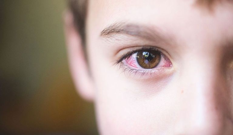 التهاب العين عند الاطفال.jpeg